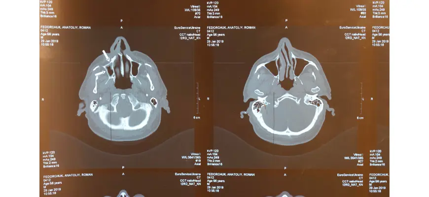 Ischemic Stroke & CT Scans: A Quick Guide