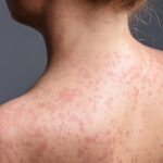 Hurricane UT Measles Risk Calculator & Local Data