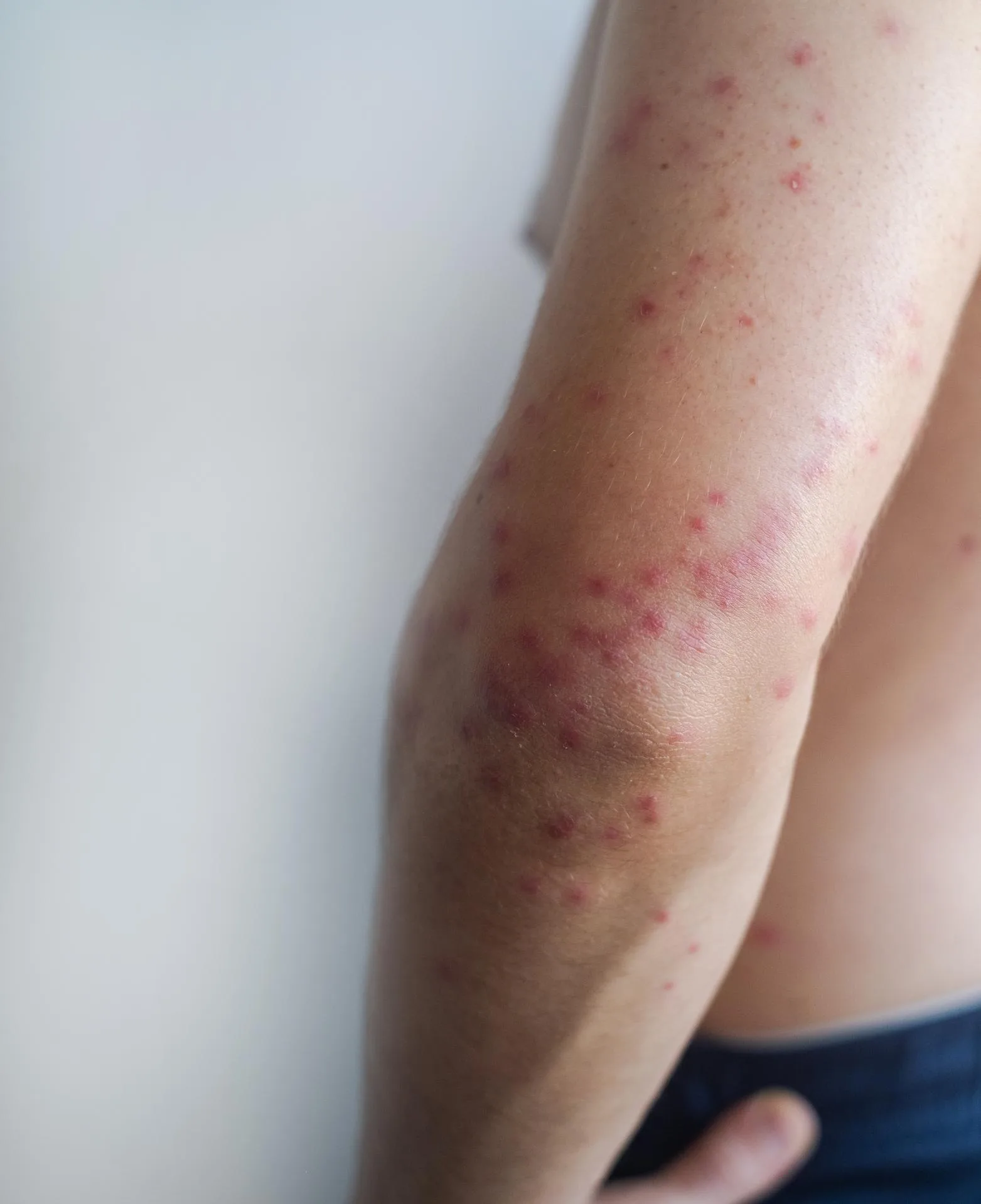 Measles Test & Risk Tool