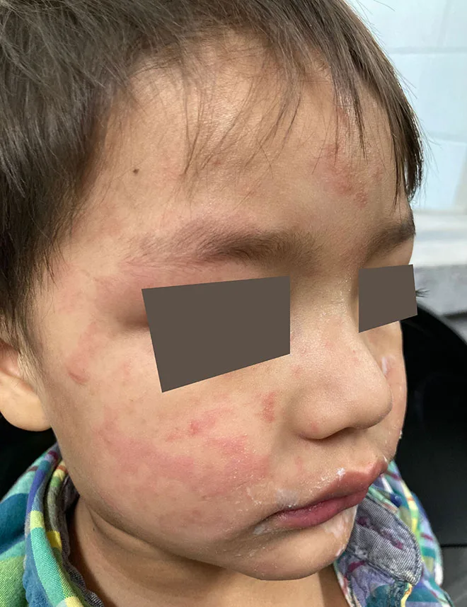 Measles Incubation Calculator